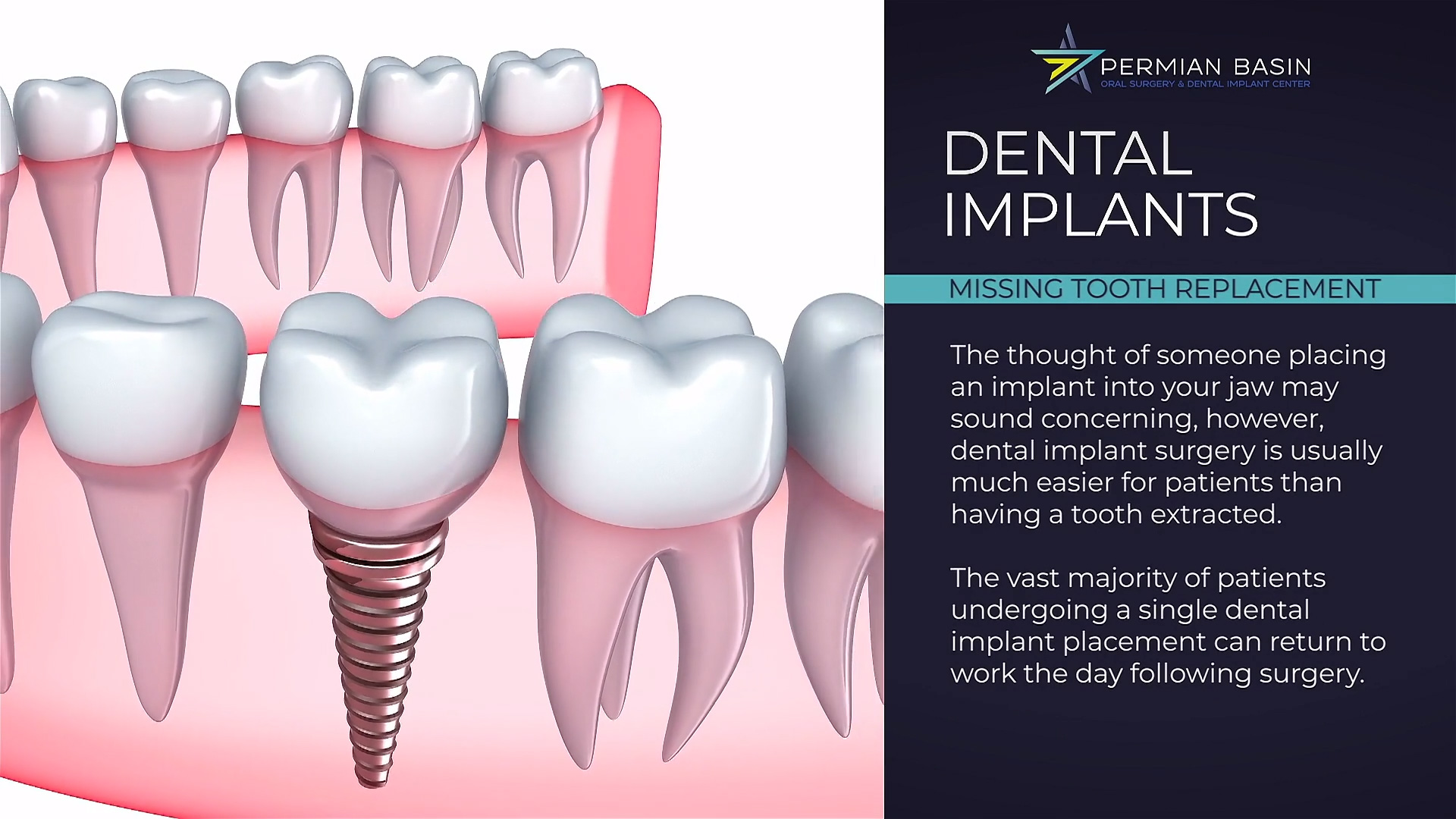 dental implants graphic | Oral Surgery | Midland | Odessa | Texas