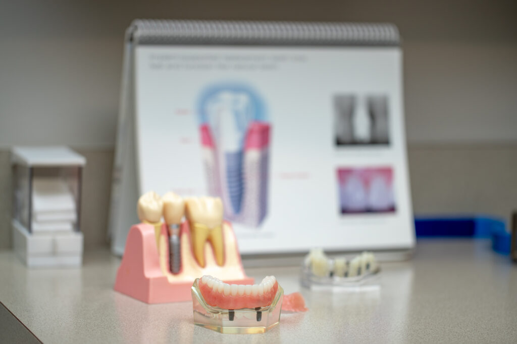 dental molds and diagram used for pre-operative instructions