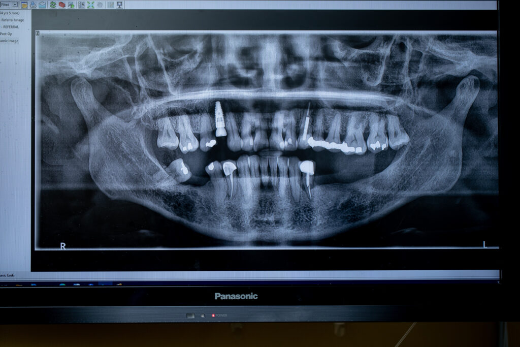x-ray of a mouth showing dental implant work before a first visit
