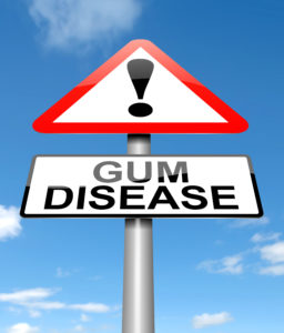 Illustration depicting a sign with a Gum disease concept