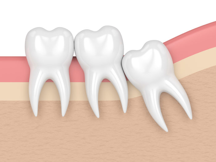 render of teeth with wisdom tooth crowding.