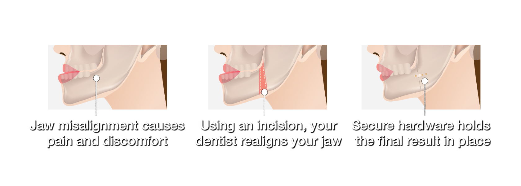 diagram explaining jaw surgery for jaw misalignment